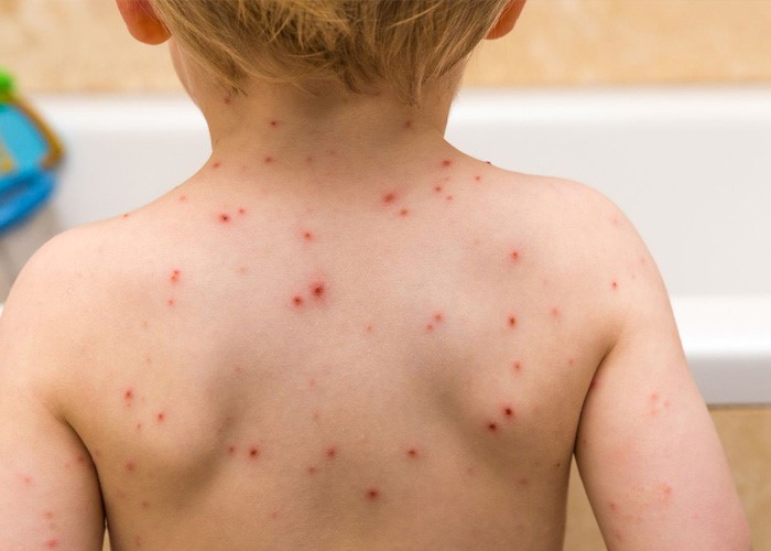 5 Bệnh Nguy Hiểm Thường Gặp Ở Trẻ Mùa Hè 5 Bệnh Nguy Hiểm Thường Gặp Ở Trẻ Mùa Hè - TRƯỜNG MẦM NON VOI CON