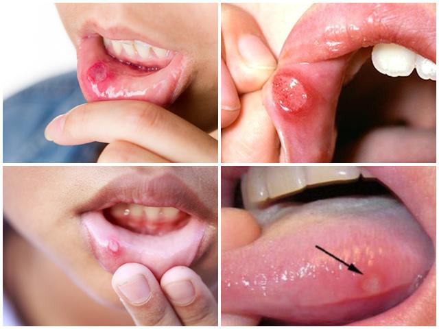 Những Mẹo Vặt Hữu Hiệu Khi Trẻ Bị Nhiệt Miệng - TRƯỜNG MẦM NON VOI CON